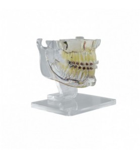 Real Series Desk-Top Orthodontic model with metal/cermamic brackets