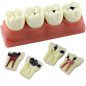 Real Series Caries evolution models set