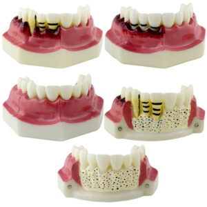 Real Series periodontal disease evolution models set